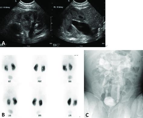 A Bilateral Hydronephrosis On Renal Sonogram B Multiple Cortical