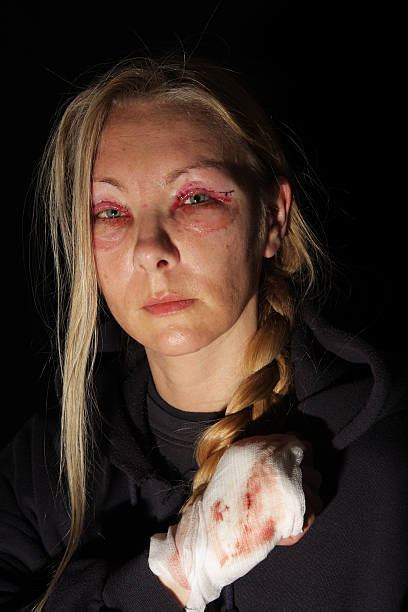 Woman with 2 black eyes. Boxing Women Female Black Eye Stock Photos, Pictures ...