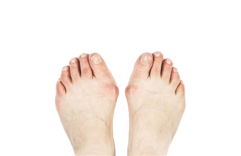 Bumps On The Outside Of Your Foot The Bunion Cure