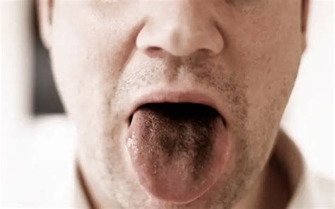 Top 5 Causes Of Black Hairy Tongue Syndrome