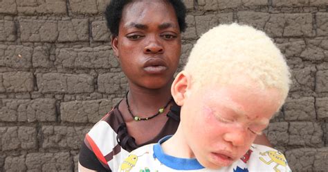Malawi Albinos Hunted And Murdered For Their Limbs Cbs News