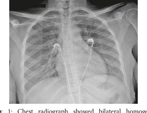 Figure 1 From Pulmonary Toxoplasmosis Diagnosed On Transbronchial Lung