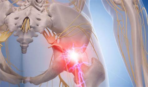 Sciatic Nerve Pain Symptoms Causes And Treatment Health And Well Being Tips