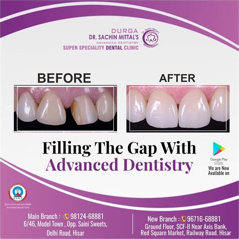 Filling the gap with most advanced dentistry – Artofit