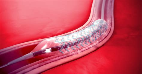 Safe Stents And Implants Saxocon As