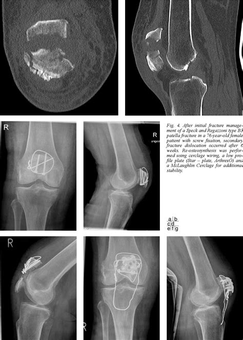 Figure 1 From Patellar Fractures A Review Of Classification Genesis