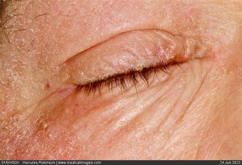 Stock Image Dermatology Atopic Eczema Very Dry Scaly Skin On The Face