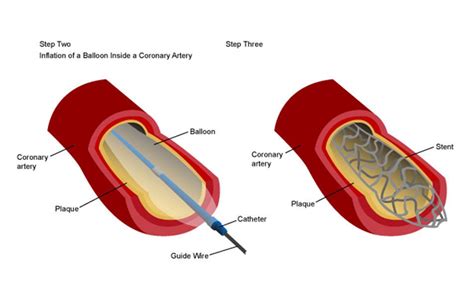 Coronary Angiography And Angioplasty Treatment In Hiranmagri Extension