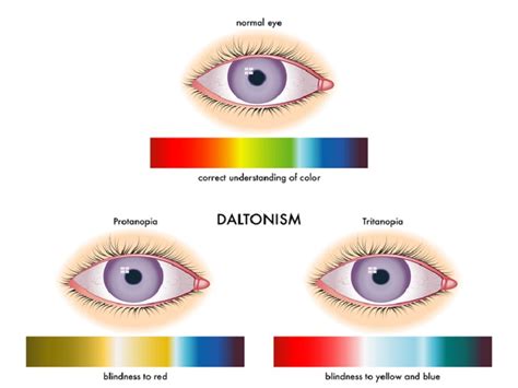 Colour Blindness Symptoms Causes And Treatments Effy Moom Free Coloring Picture wallpaper give a chance to color on the wall without getting in trouble! Fill the walls of your home or office with stress-relieving [effymoom.blogspot.com]