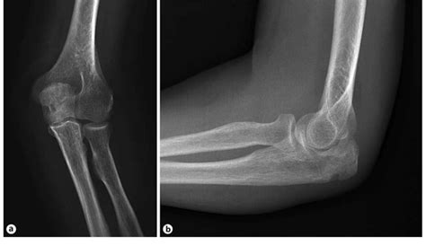 A B Plain Radiographs Of The Left Elbow Showing A Fracture Of The
