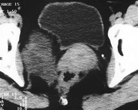 Ct Scan Demonstrating The Oval Shaped Lesion Arrow Displacing