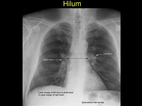 Ppt The Chest X Ray Powerpoint Presentation Free Download Id5750796