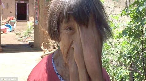 Chinese Woman Named Elephant Woman For Tumour On Face Daily Mail Online