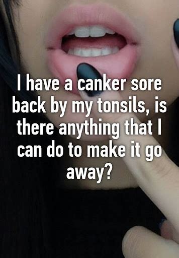 Everything You Need To Know About Canker Sore On Tonsil