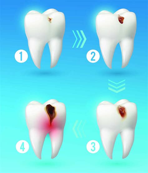 What Causes Cavities Total Care Dental Holistic Dentistry