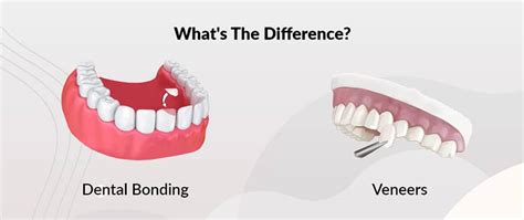 Dental Bonding Vs Veneers How To Decide Between Them La Dental Clinic