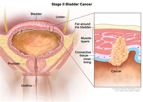 Bladder Cancer Treatment Pdq Health Professional Version Nci