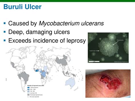 This nodule can turn into an ulcer. PPT - Structure and Function of the Skin PowerPoint ...
