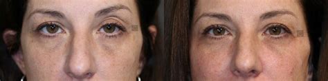 Patient 57951131 Wrinkle Relaxer Before And After Clinic 5c