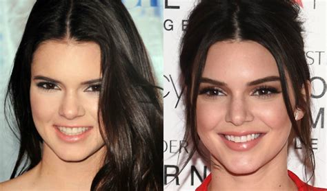 Kendall Jenner Plastic Surgery - ipbs | Keeping Up With Kendall