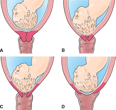 Pelvic Floor Symptoms Pregnancy Review Home Co