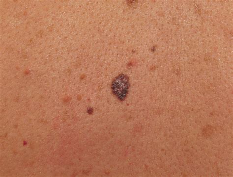 These are the most common form in the feet and don't spread in early stages. Quotes About Skin Cancer. QuotesGram
