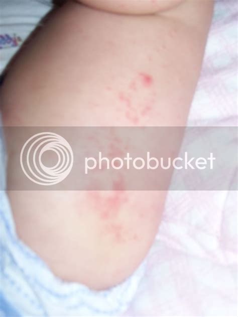 Rashes On Toddlers Legs Pictures Photos