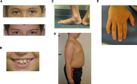 47xyy Syndrome Clinical Phenotype And Timing Of Ascertainment The Journal Of Pediatrics