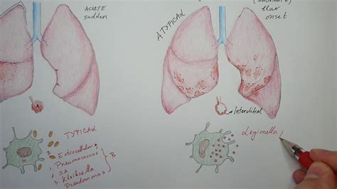 Typical Vs Atypical Pneumonia Youtube