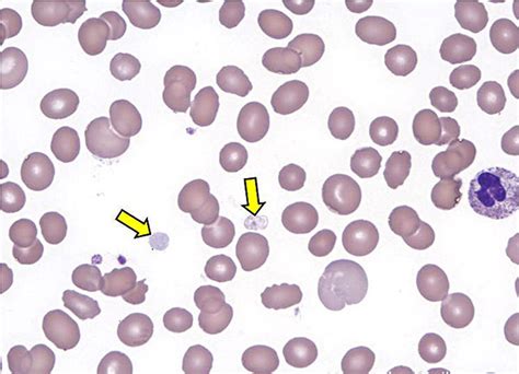 Platelet Count High And Low Platelet Count Causes And Treatment