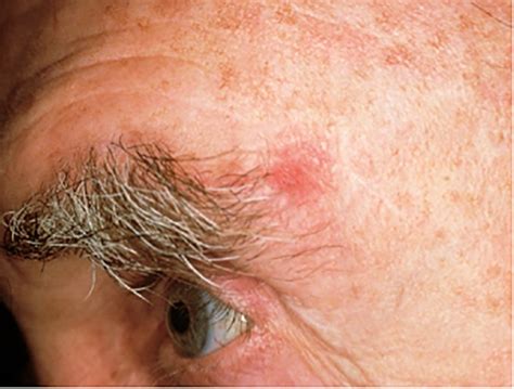 Basal Cell Skin Cancer On Nose Cancer Symptom