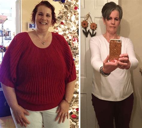 15 Incredible Weight Loss Surgery Before And After Best Product Reviews