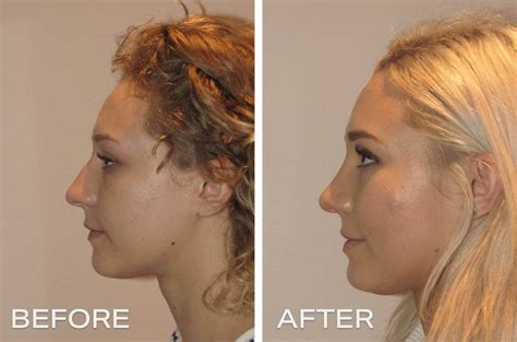 Nose Surgery Before And After Photos Dr Hunt Sydney Plastic Surgeon