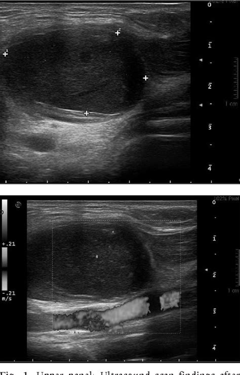 Figure 1 From Neck Epidermoid Cyst Mimicking Tuberculosis At Ultrasound