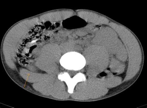 Appendicitis Ct Sumers Radiology Blog