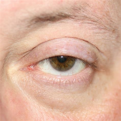 Ptosis Droopy Eyelid Causes Treatment Milan Eye Center