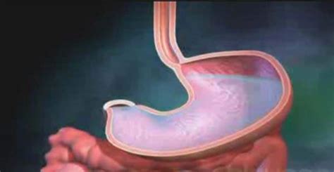 The most common symptoms of a duodenal ulcer are waking at night with upper abdominal pain and upper abdominal pain that improves with. Peptik Ülser Nedir? - Hemen Sağlık