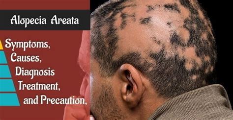 Alopecia Areata Causes Symptoms Diagnosis And Precautions﻿