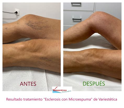 Esclerosis De Varices Con Microespuma Eliminar Varices Málaga