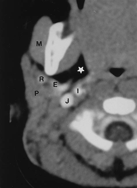 Swelling At The Angle Of The Mandible Imaging Of The Pediatric Parotid