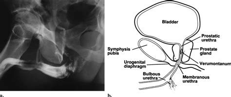 Anterior Urethral Injury Following Blunt Trauma Type V Urethral