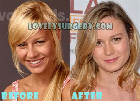 Brie Larson Plastic Surgery Nose Job Lovely Surgery Celebrity