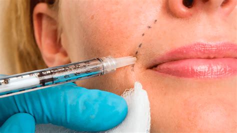 The Complete Guide To Dermal Fillers From Dos And Donts To Tips For