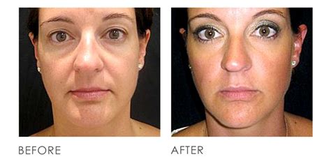 Ultherapy Before After Premier Clinic Cn