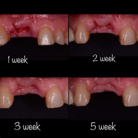 How To Heal Gums After A Tooth Extraction With Pictures Tooth Reverasite