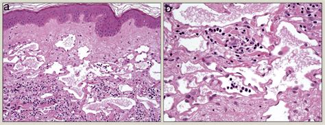 An Update On Cutaneous Vascular Tumours Diagnostic Histopathology