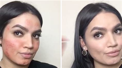 This Makeup Tutorial For Covering Up Acne Is Making Instagram Freak Out