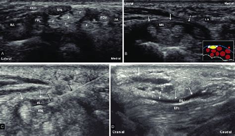 Fpl circuit is a system of inhouse leagues which offer the best competitive pugging experience, where the professional players meet the best upcoming talents. (A-D): (A) Ultrasound transverse image with probe placed on the ventral... | Download Scientific ...