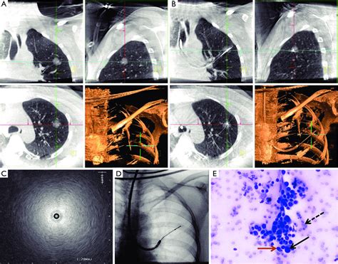 Transbronchial Lung Biopsy Under Guidance Of Mobile D Imaging And EBUS
