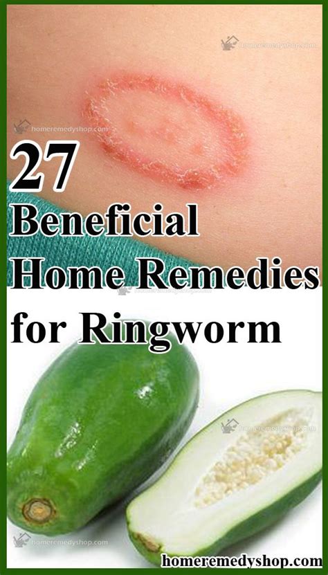 23 Beneficial Home Remedies For Ringworm Home Remedies For Ringworm